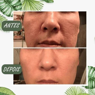 Mascara Removedora de Cravos - Green Mask®